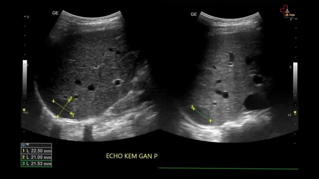 Sieu am Q7 xin chia se nhung hinh anh sieu am U mach mau gan. sieu am bung tong quat