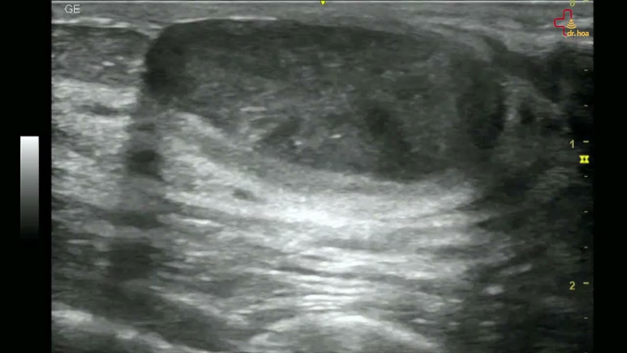 Sieu am Q7 xin gioi thieu case sieu am tuyen vu Buou soi tuyen dien hinh thuong gap o phu nu tre