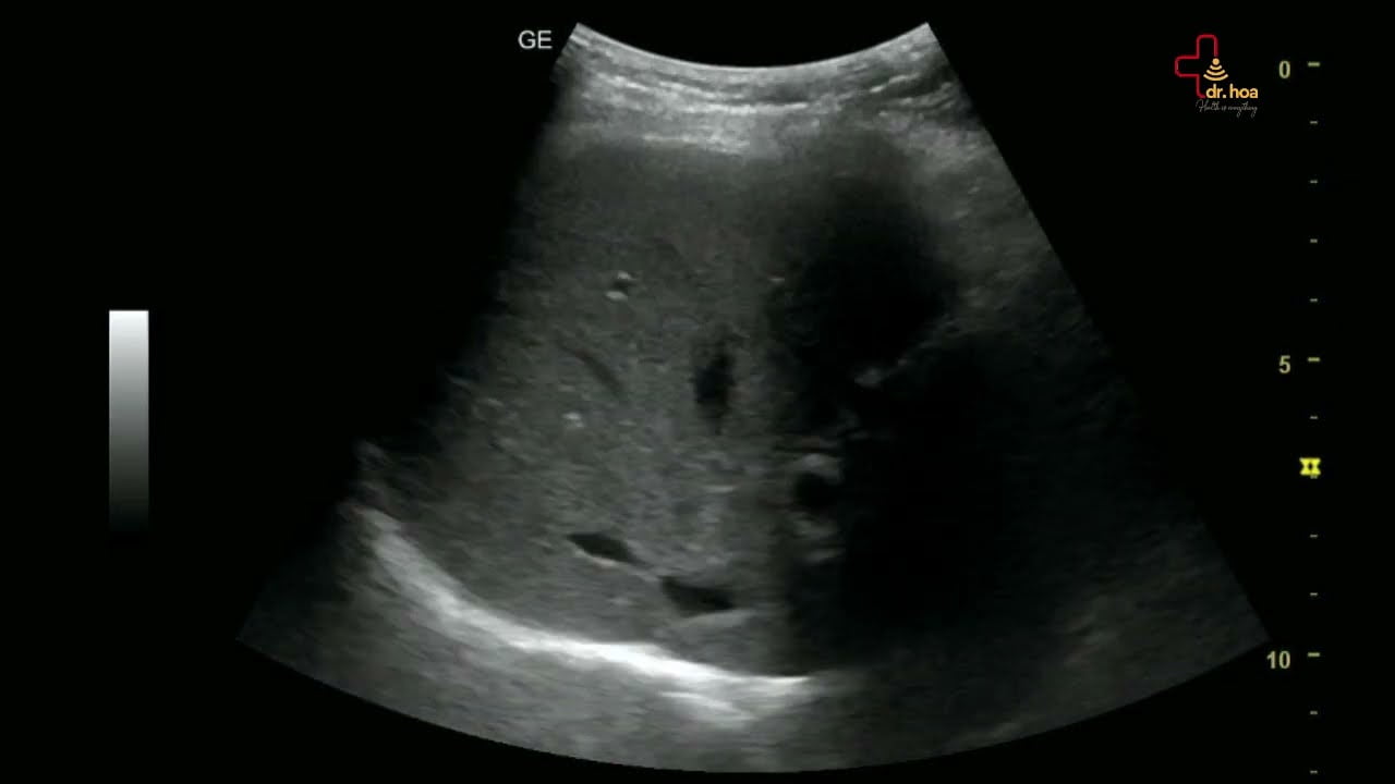 Sieu am bung tong quat kiem tra gan mat. Ket qua on a