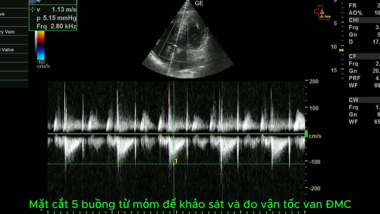 Siêu âm tim, khảo sát và đo van động mạch chủ.