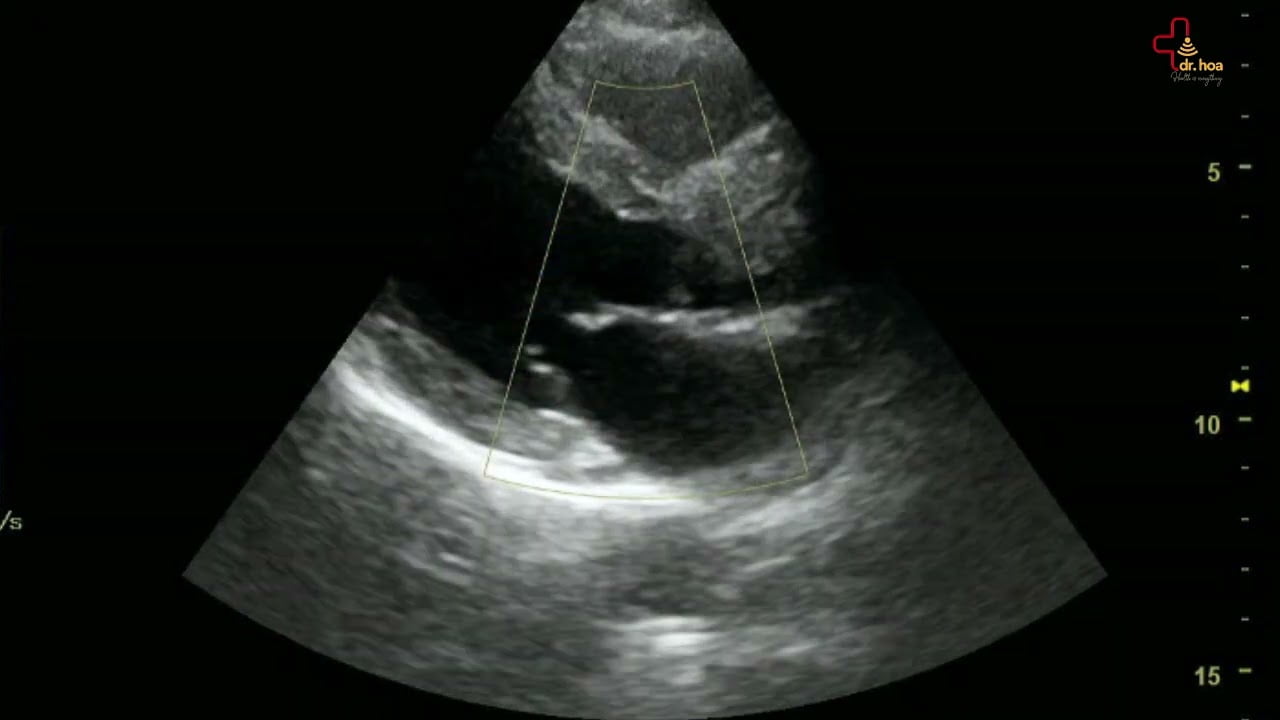 Sieu am tim hinh anh ro dep