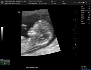 Hình ảnh đo độ mờ da gáy.