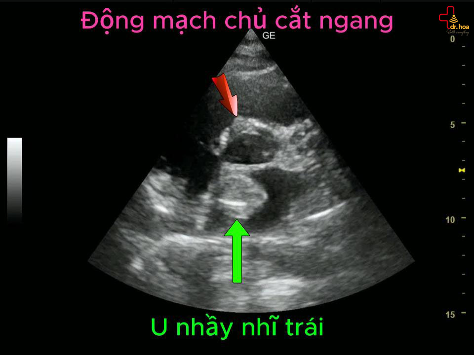 U nhầy nhĩ trái, động mạch chủ cắt ngang.