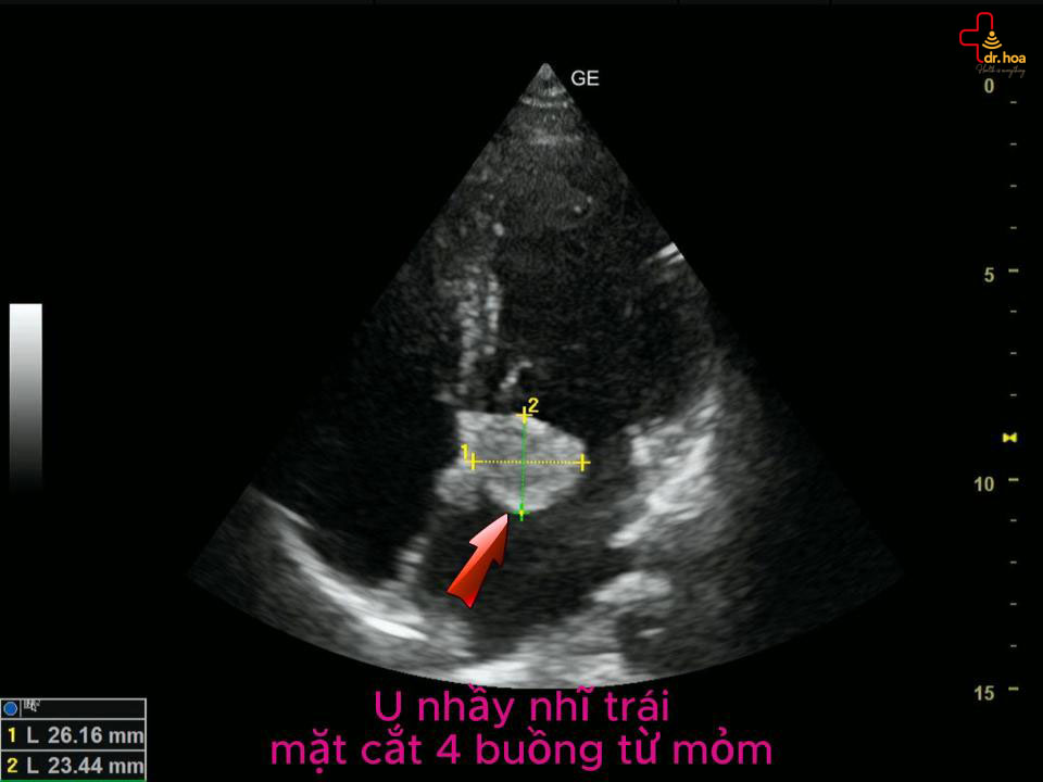 U nhầy nhĩ trái, mặt cắt 4 buồng từ mỏm.