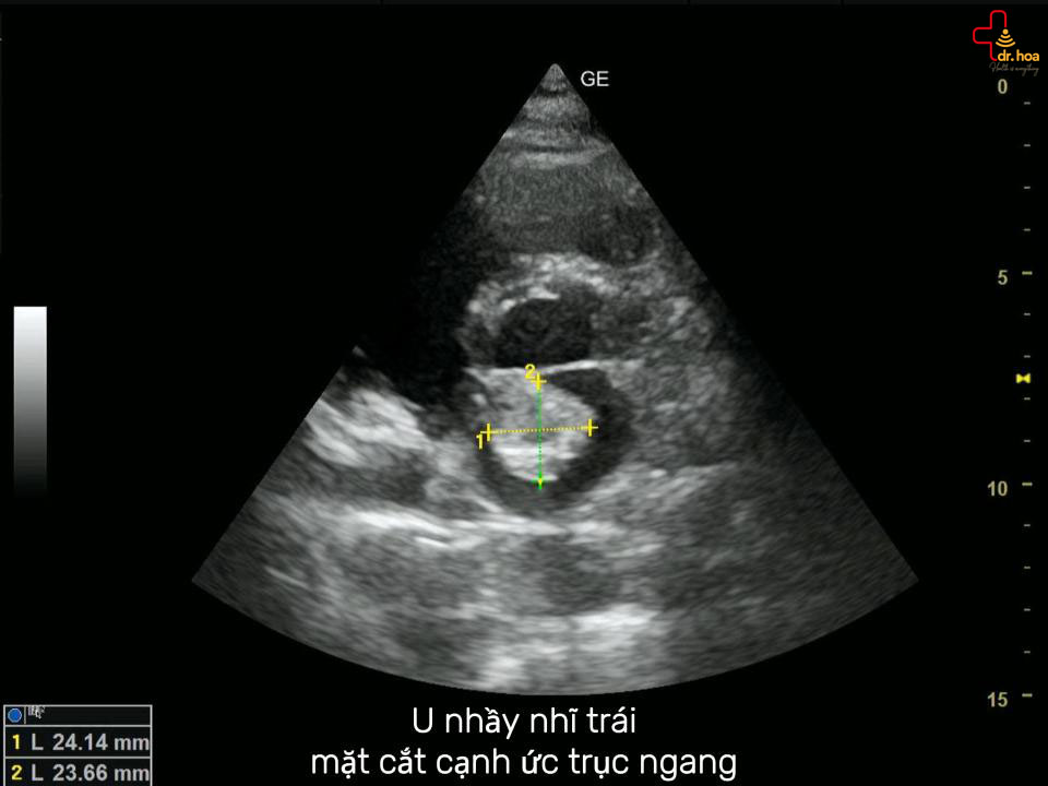 U nhầy nhĩ trái, mặt cắt cạnh ức trục ngang.