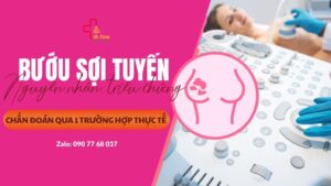 Bướu sợi tuyến - nguyên nhân, triệu chứng và chẩn đoán.