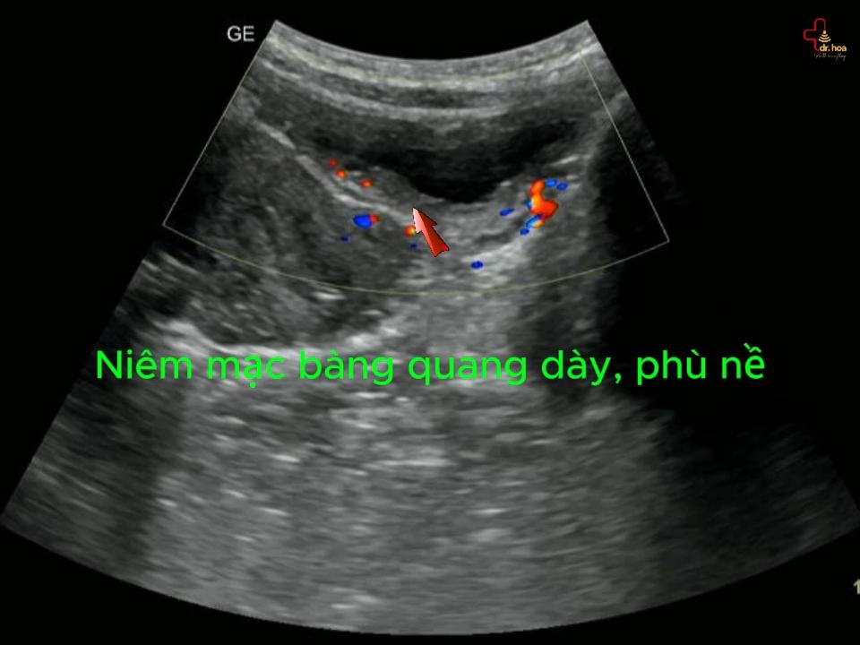 Hình ảnh siêu âm bụng -nhiễm trùng tiểu ở nữ.