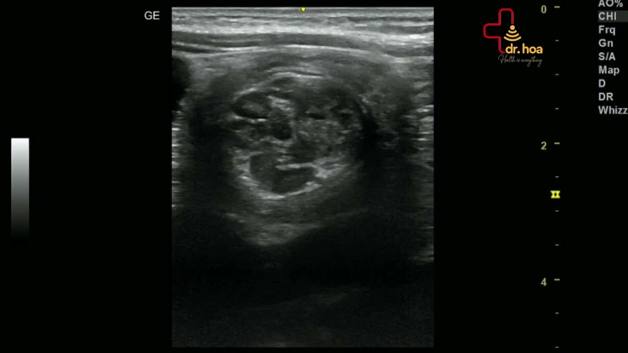 Hình ảnh siêu âm bụng phát hiện lồng ruột.