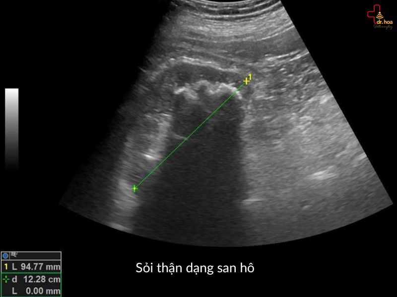 Hình ảnh sỏi thận dạng san hô qua siêu âm bụng tổng quát.