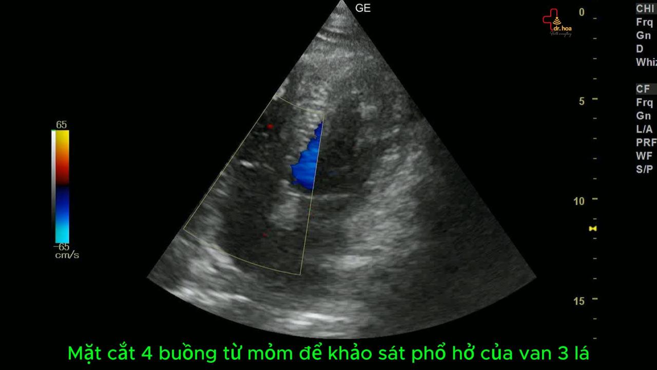 Siêu âm tim khảo sát phổ hở của van 3 lá.