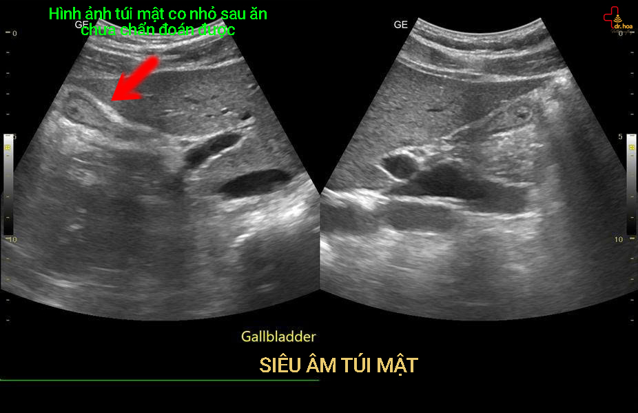 Hình ảnh siêu âm bụng tổng quát khu vực túi mật.