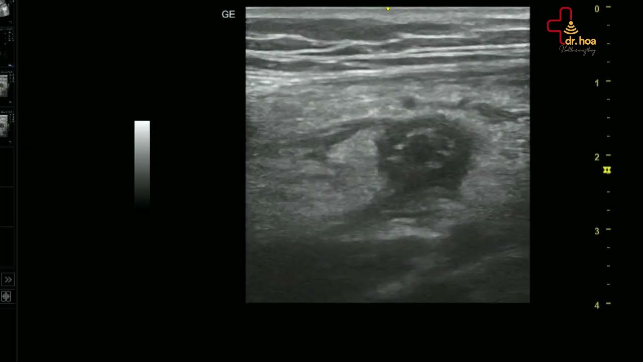 Hình ảnh siêu âm bụng tổng quát phát hiện viêm ruột thừa cấp.