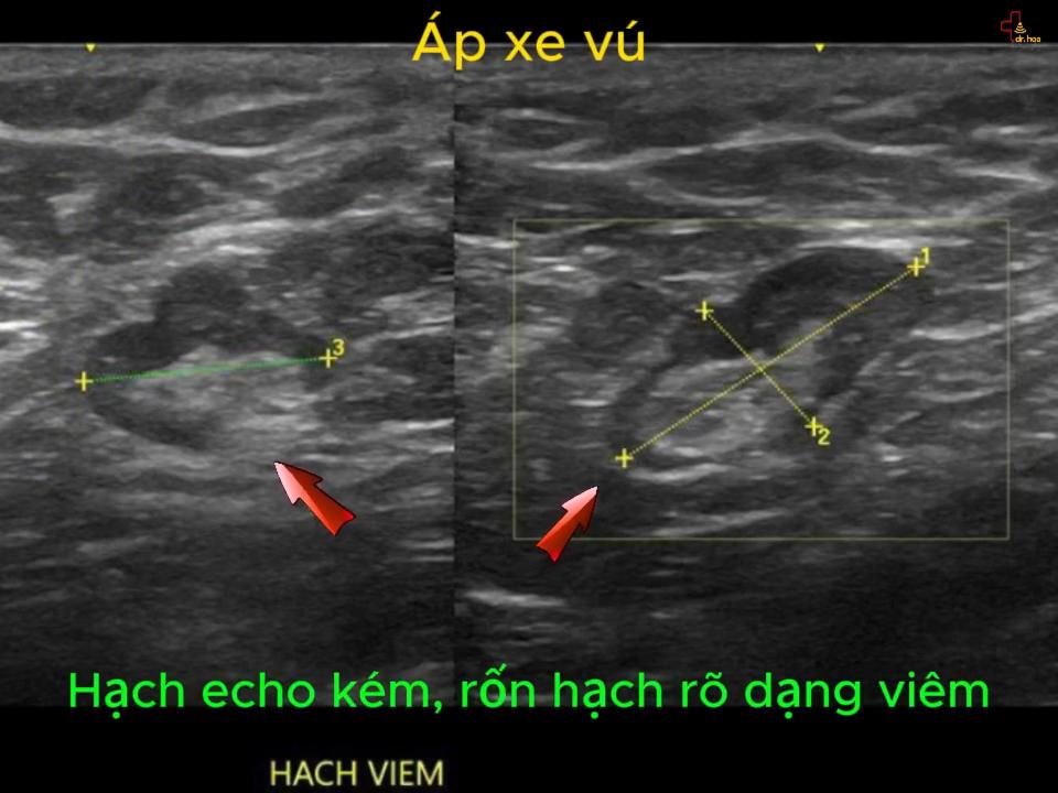 Áp xe vú hình ảnh hạch nách echo kém vỏ hạch dày dạng viêm còn rốn hạch.