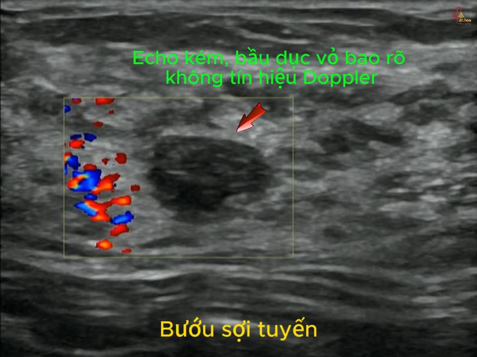 Bướu sợi tuyến vú khối echo kém, hình bầu dục bờ không đều không tín hiệu Doppler.