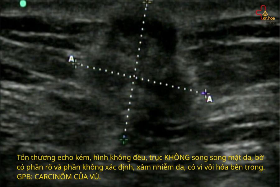Hình ảnh siêu âm tuyến vú - BIRADS 5.