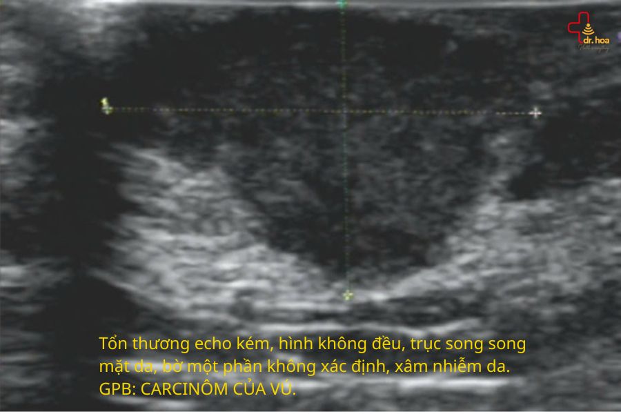 Hình ảnh siêu âm tuyến vú – CARCINÔM của vú xâm nhập dạng NST, độ 2.
