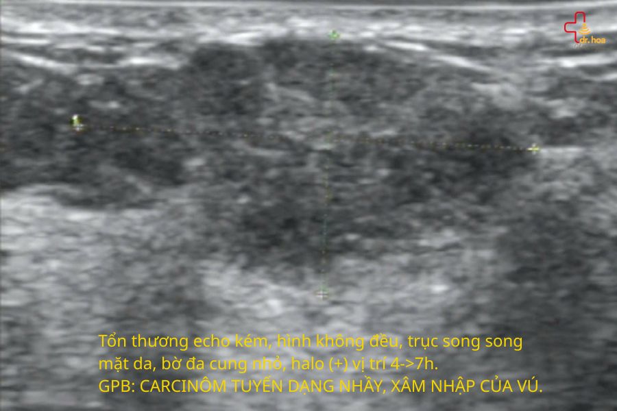 Hình ảnh siêu âm tuyến vú – CARCINÔM tuyến dạng nhầy, xâm nhập của vú.