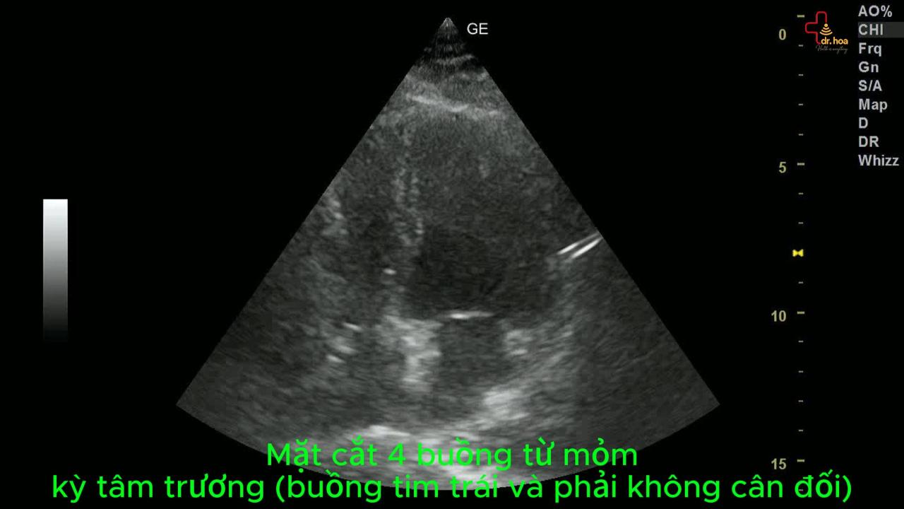 Siêu âm tim – buồng tim trái và phải không cân đối.
