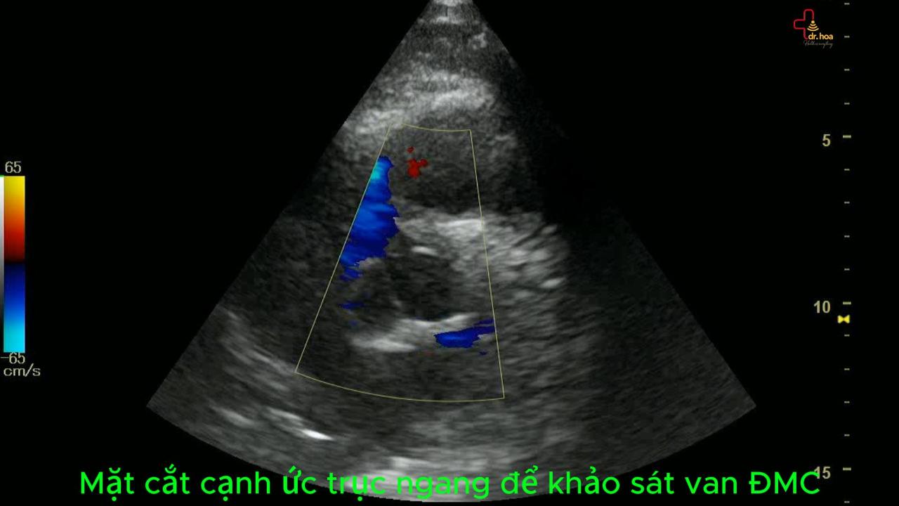 Siêu âm tim khảo sát van động mạch chủ.