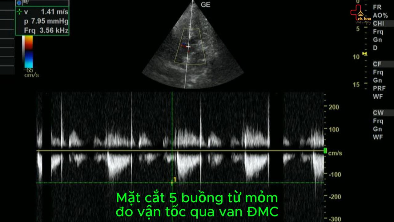 Siêu âm tim – Mặt cắt 5 buồng từ mỏm, đo vận tốc qua van ĐMC.