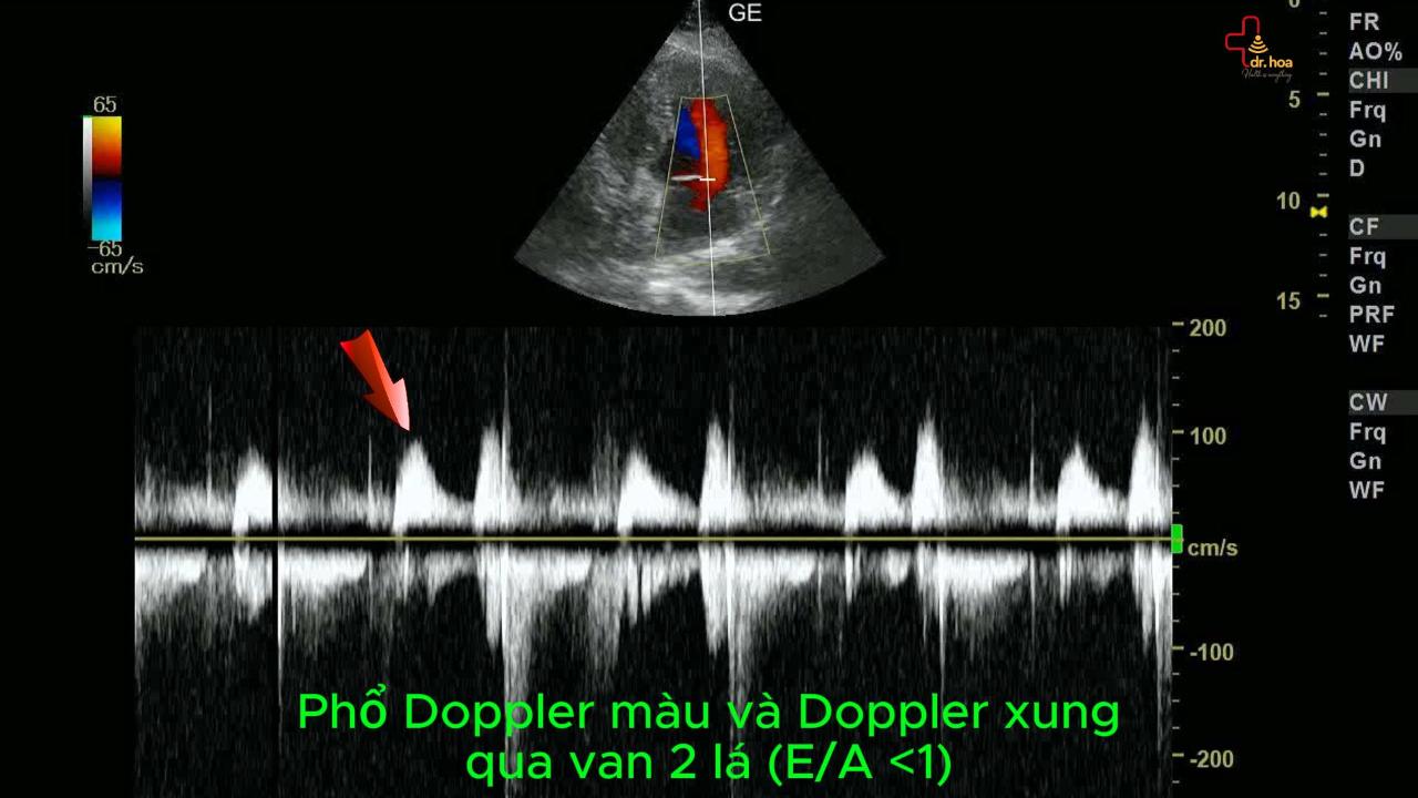 Siêu âm tim – phổ Doppler màu và Doppler xung qua van 2 lá.
