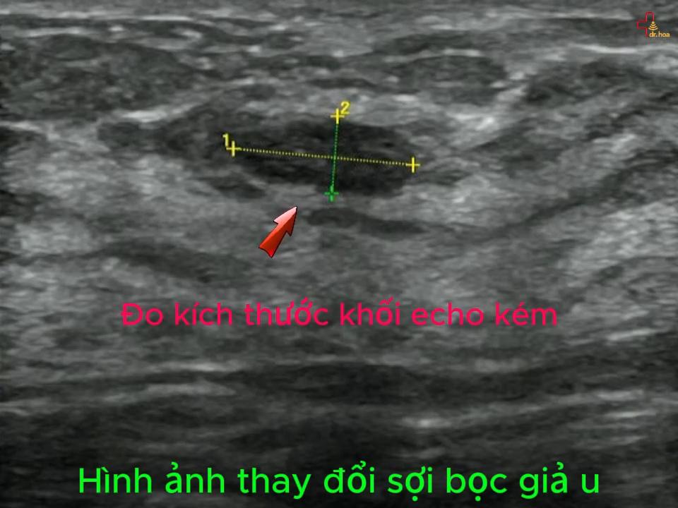 Thay đổi sợi bọc giả u đo kích thước khối echo kém.